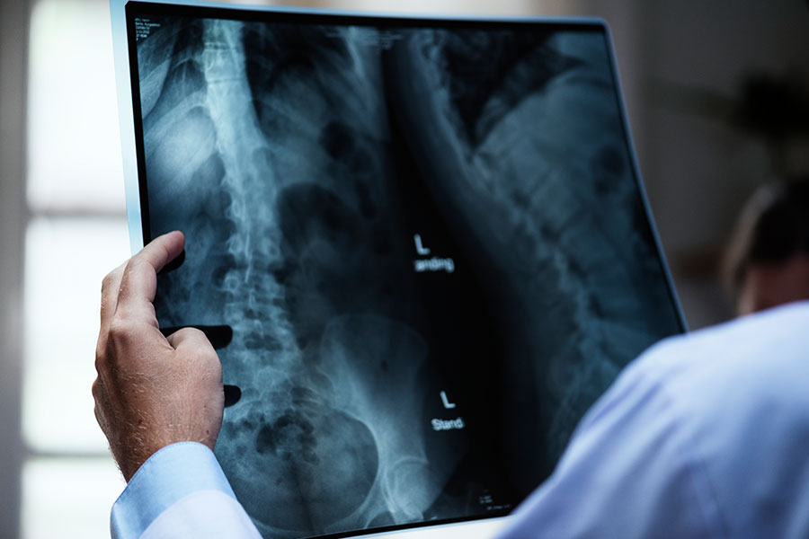 Radiografía escoliosis síndrome marfan